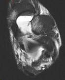 Figure 3 for case Medial subtalar joint dislocation( RID3029 )